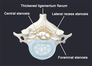 lateral recess lumbar