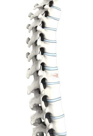 Spinal Compression Fractures: A Comprehensive Overview